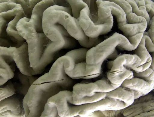 A closeup of a human brain affected by Alzheimer's disease, is displayed at the Museum of Neuroanatomy at the University at Buffalo in Buffalo, N.Y., on Oct. 7, 2003. According to findings published Wednesday, Feb. 21, 2024 in the New England Journal of Medicine, Alzheimer’s quietly ravages the brain long before symptoms appear and now scientists are getting a closer look at the domino-like sequence of those changes _ a potential window to one day intervene. (AP Photo/David Duprey)